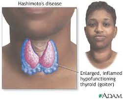 Memahami Hashimoto's Tiroiditis