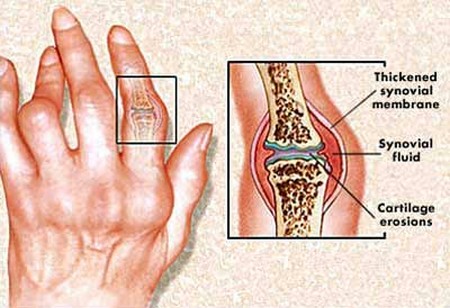 Memahami Rheumatoid Arthritis (RA/Rematik)﻿