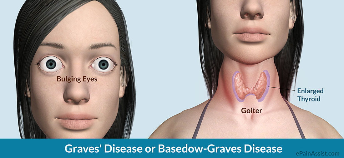 Memahami Graves' Disease﻿