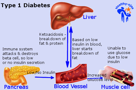 Memahami Diabetes Melitus Type 1