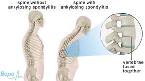 Memahami Autoimun Ankylosing Spondylitis 2